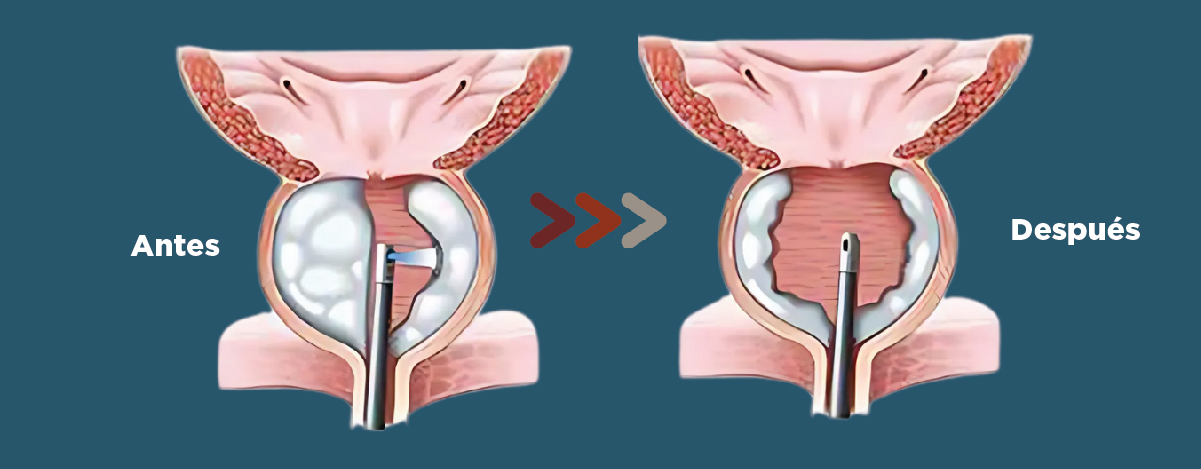 Comparación antes y después HoLEP